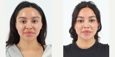 25-34 year old woman treated with Rhinoplasty - 27 year old 1 month after primary Rhinoplasty by Dr. Robert Chouake.