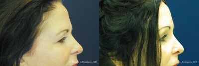 Brow Lift - 55-64 year old woman treated with Brow Lift