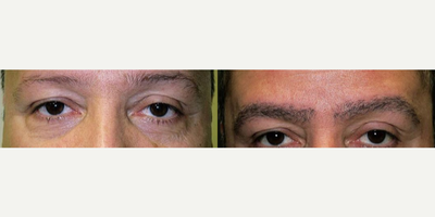Man treated with Eyebrow Transplant - Man treated with Eyebrow Transplant