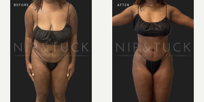 35-44 year old woman treated with Mommy Makeover, Brazilian Butt Lift, Lipo 360, Breast Reduction - 38-year-oldHeight: 5'5Weight: 165BMI: 27.5Operative Procedure: Mommy Makeover:Brazilian buttlift(fat transfer to buttocks, liposuction of abdomen, flanks, back,), breast reductionLiposuction: \tAbdomen/flanks:__1300__mL\tBack:_1000___mLSpecimen: Breast tissue: _256___/ _268___g6 months post-op