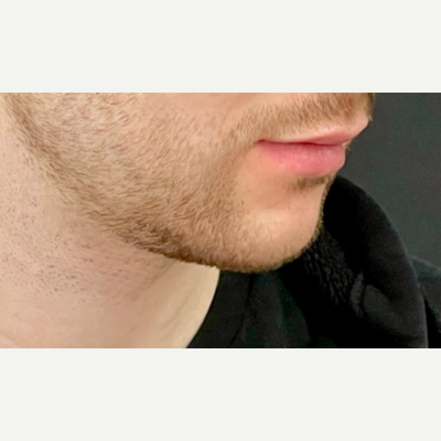 25-34 year old man treated with Chin Implant, Cheek Augmentation, Jaw Implants - Chin & Jaw Implant