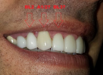 Why are my veneers turning out the wrong shade/color? (photos) Doctor