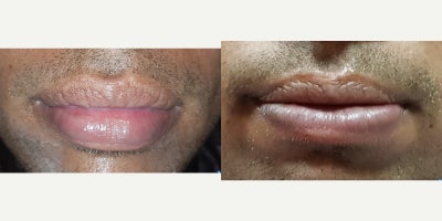25-34 year old man treated with Lip Reduction - 30 year old who underwent a lip reduction