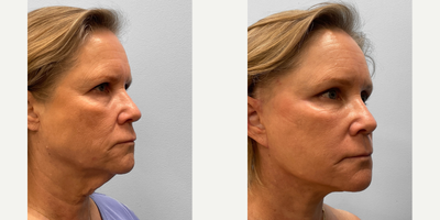 55-64 year old woman treated with Facelift, Brow Lift, Laser Resurfacing, Facial Fat Transfer - This woman in her early sixties wanted to enhance the overall appearance of her face and address fine lines, loose skin, and drooping eyelids.  She and Dr. Howell discussed her options for facial rejuvenation of which she chose to proceed with a facelift, endoscopic browlift, TFX CO2 laser resurfacing and fat injections.  Her results look natural with great symmetry and brow function. She is shown before and three months afterwards.