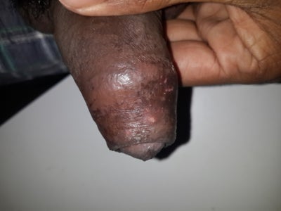 Wounds On Penis 41