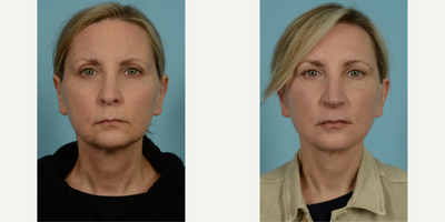 45-54 year old woman treated with Facelift, Lower Facelift, Neck Lift, Facial Fat Transfer, Laser Resurfacing, Dermabrasion - The 54-year-old female patient pictured above was driven by considerable changes of aging, particularly evident in the areas around the jowls and cheeks, thin lips, the early appearance of vertical lines around the mouth, and changes in her neck. This active runner and yoga enthusiast sought out the exceptional Facelift/Minilift by Dr. Mustoe in Chicago, renowned for delivering natural and not overstretched results. The patient was referred by a friend who ten years prior had trusted Dr. Mustoe with a similar surgery.Under IV sedation and local anesthesia, Dr. Mustoe employed a deep plane facelift, fat grafting around the mouth, ablative laser, and spot dermabrasion around the mouth and to her forehead. Her ease throughout the process was likely a result of the widely recognized expertise and care of Dr. Mustoe and his staff at TLKM Plastic Surgery.Post-procedure, the patient's results were dramatically visible in her naturally rejuvenated and fresh appearance. The transformation was balanced, avoiding the appearance of being overstretched, which was crucial for her. Comfort and satisfaction with the Facelift/Minilift by Dr. Mustoe in Chicago was evident in the patient's glowing post-procedure expression, all while retaining the natural characteristics that made her unique. The outcomes bear witness to Dr. Mustoe's excellence, a culmination of over 30 years of experience combined with a prestigious background of education and research from Harvard to advisory positions with the U.S. Food & Drug Administration.