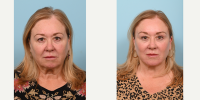 55-64 year old woman treated with TCA Peel - This patient in her late 50s had a facelift, upper blepharoplasty, temporal browlift, buccal fat removal and lower eyelid TCA peel. Although it sounds like many procedures, since they are all small areas they can be done at the same time. This allows for a natural looking face that is in harmony.