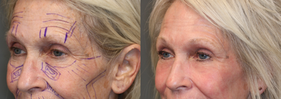 CO2 Laser and Stem Cell Fat Transfer - Laser resurfacing with fractionated CO2 and stem cell fat transfer.