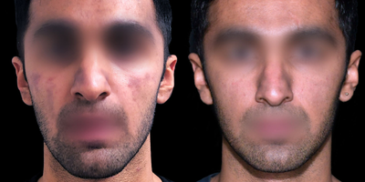 25-34 year old male treated with Clear and Brilliant - This patient underwent multiple clear and brilliant laser treatments. Each treatment was spaced 6-8 weeks apart.