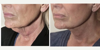 67 year old woman treated with MyEllevate, Mini Facelift - 67 year old female 10 days following the MyEllevate Plus procedure involving placement of the MyEllevate suture support system to define the mandibular border, liposuction of the neck and division of the platysma bands, and a mini-lift skin excision.