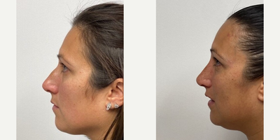 Woman treated with Rhinoplasty - Woman treated with Rhinoplasty.