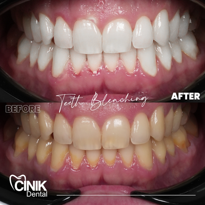 25-34 year old man treated with Teeth Whitening - Teeth Whitening