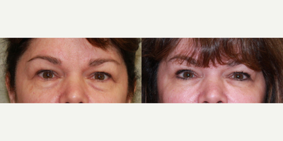 55-64 year old woman treated with Belotero - Pt was not happy with her under eye hollows, she was treated with belotero to the under eye area.