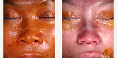 45-54 year old woman treated with Asian Rhinoplasty, DCF Rhinoplasty and Alar Base Reduction - 45-54 year-old woman treated with DCF rhinoplasty and alar base reduction. Patient has had prior fillers in her nose in the past. She felt that despite the filler, her nose still appeared flat and wide, especially at the tip. In order to provide the structure and refinement in her nose that she was seeking, her nasal bridge was augmented with a DCF graft. Her nasal tip was refined with increasing projection and soft tissue and cartilage debulking. To address the wide nostrils, she also underwent an alar base reduction. These procedures provided a significant but natural change to her nose.