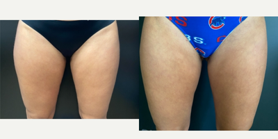 35-44 year old woman treated with Emtone - Improved texture and toning of thighs after Emtone