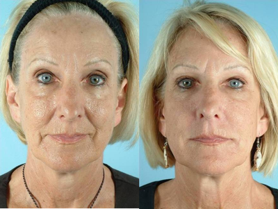 55 Year Old Female Treated for Unwanted Facial Lines - 
	55 Year Old Female Diagnosis: Unwanted Facial Lines Procedure: Juvederm Dermal Filler in Nasolabial Fold and Marionette Lines
