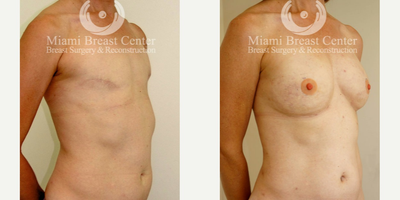 45-54 year old woman with Breast Reconstruction and fat grafting - 53 year old woman with bilateral mastectomy uses fat transfer to reconstruct her breasts. After three sessions of grafts, she achieves symmetrical breast that look and feel natural.