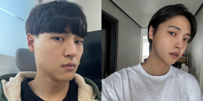 18-24 year old man treated with Jaw Reduction, Cheekbone Reduction - Face Contour 3 Combo (cheekbone, jawline and chin)