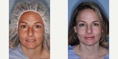 Woman treated with Lip Fillers, Lip Implants - Woman treated with Lip Fillers, Lip Implants