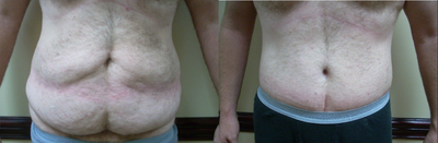 35-44 year old man treated with Male Tummy Tuck - extended tummy tuck  belt lipectomy (body lift)
