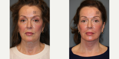 Revision Necklift - Prior recent necklift with another surgeon left her with poor scars, a blunted jawline and significant neck deformity. This was fixed with a revision necklift.