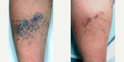 Man treated with Excel V - Man treated with Excel V