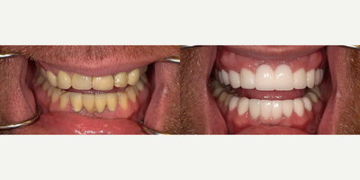 Man treated with Dental Bridge, Smile Makeover - Were very proud of our latest Smile Makeover! This patients previous work was made to match his natural tooth color but he wanted a more youthful look. Dr. Maddahi revitalized his smile with new upper and lower bridges.