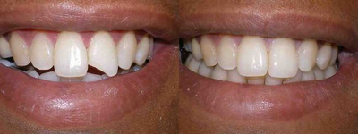 30-39 year old woman treated with Dental Bonding - 30-39 year old woman treated with Dental Bonding