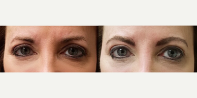 35-44 year old woman treated with Permanent Makeup - MicroBlading Before and After pictures by Dr. Deborah Sillins of Rejuvene Plastic Surgery in Northern Kentucky and Cincinnati.