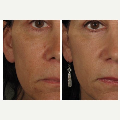 45-54 year old woman treated with Halo Laser - Pt. had a single Halo treatment