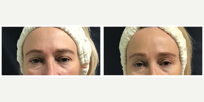 45-54 year old woman treated with Pelleve - Pelleve full face