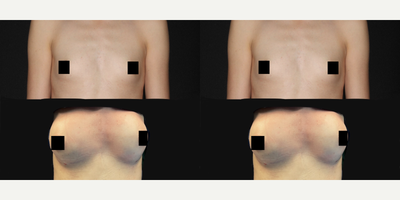 25-34 year old woman treated with Breast Fat Transfer - Before and immediately after breast augmentation with fat transfer, using the patient's own fat.