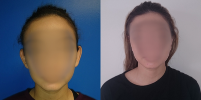 35-44 year old woman treated with Ear Surgery - Ear set back otoplasty with creation of sharper antihelical folds. performed under local anesthesia.