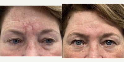 55-64 year old woman treated with Fraxel Laser - The patient sustained injury to the glabellar area and underwent treatment of the scar with the fraxel laser (3 sessions). The results are 5 months after the laser treatment.