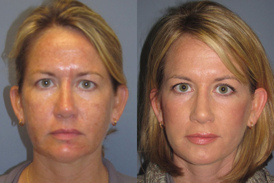 38 year old , Obagi Blue Peel ,Lite Lift, Neck Lift   - 	This 38 year old women had a Lite Lift a modified face lift.To enhance the benefits from her procedure she also had a Blue Peel.Notice in her post photos improved skin textured adding to her beautiful youthful beauty.