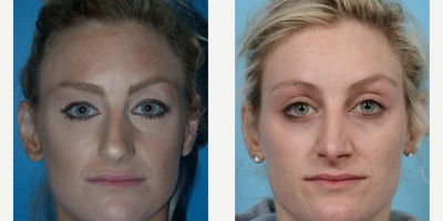Woman treated with Revision Rhinoplasty - Woman treated with Revision Rhinoplasty