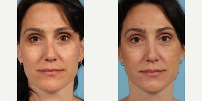 Woman treated with Revision Rhinoplasty - Woman treated with Revision Rhinoplasty