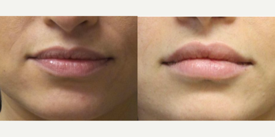 Woman treated with Juvederm - Juvederm.
