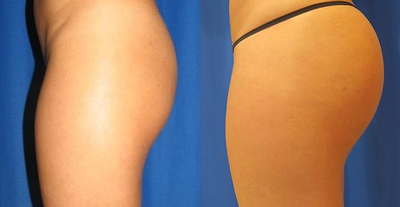 Woman treated with Butt Implants - Woman treated with Butt Implants