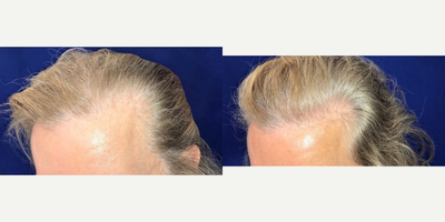 45-54 year old man treated with Hair Loss Treatment - Patient is 6 months post op his PRP procedure