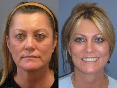 Face Lift/ Lite Lift - 
	Notice this patients jawline ,no marionette lines and refreshed appearance.
