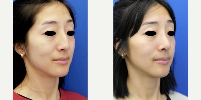 25-34 year old woman treated with Asian Rhinoplasty - She makes it clear that she does not want an eurocentric nose or barbie tip nose. She desires a straight dorsum without the usual curvilinearity. Postoperative 3 months this is exactly what she is looking for. I would call this preservation ethnic rhinoplasty.