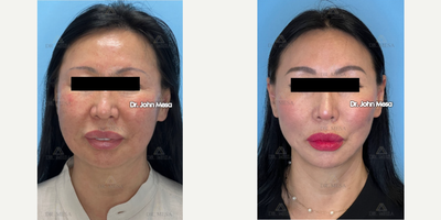 45-54 year old woman treated with Buccal Fat Removal, Chin Liposuction, FaceTite, AccuTite, NeckTite, Morpheus8 - 45-54 year old woman treated with Buccal Fat Removal 90% , Extended Chin Liposuction, FaceTite, AccuTite, NeckTite, Morpheus8