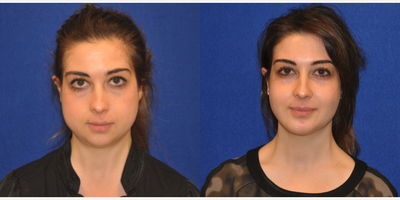 Chin Implant - Chin Implant
