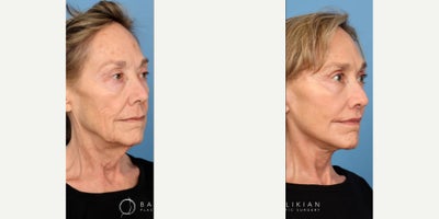 Woman treated with Facelift, Deep Plane Facelift, Neck Lift, Brow Lift, Eyelid Surgery, CO2 Laser - Woman treated with Facelift, Deep Plane Facelift, Neck Lift, Brow Lift, Eyelid Surgery, CO2 Laser