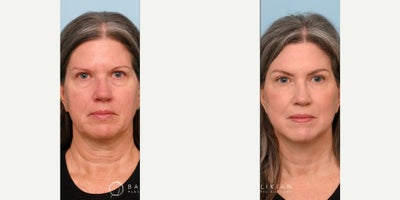 Woman treated with Facelift, Deep Plane Facelift, Neck Lift, Brow Lift, Eyelid Surgery, CO2 Laser - Woman treated with Facelift, Deep Plane Facelift, Neck Lift, Brow Lift, Eyelid Surgery, CO2 Laser