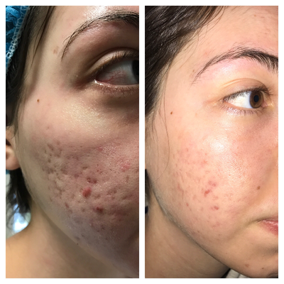 25-34 year old woman treated with Venus Viva - Venus viva Nani fractional ablative micro needling and RF radio frequency energy