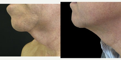 58 year old man treated with the CoolMini - Patient had 1 CoolSculpting treatment under his chin.