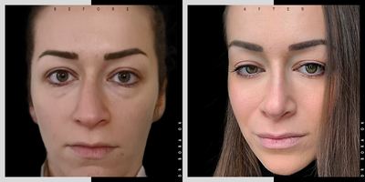 25-34 year old woman treated with Eyelid Surgery - 25-34 year old woman treated with Eyelid Surgery