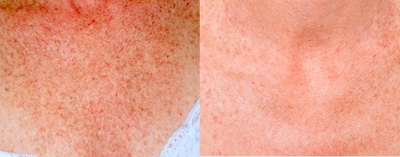 IPL Treatment for Chest - 
	performs IPL treatments to correct sun damage on patient&#39;s chest.
